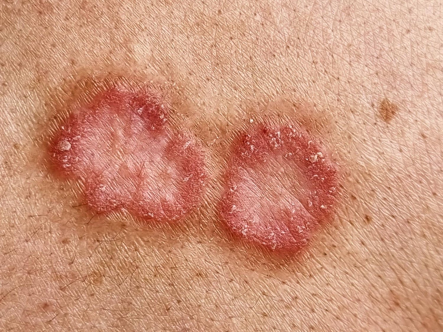 人類皮膚感染貓癬的環狀紅疹近照